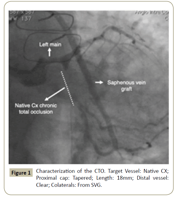 When Shorter Is Better A Novel Technique For Shortening A Guide Catheter Without Losing Guidewire Position Insight Medical Publishing