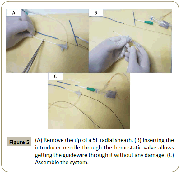 When Shorter Is Better A Novel Technique For Shortening A Guide Catheter Without Losing Guidewire Position Insight Medical Publishing