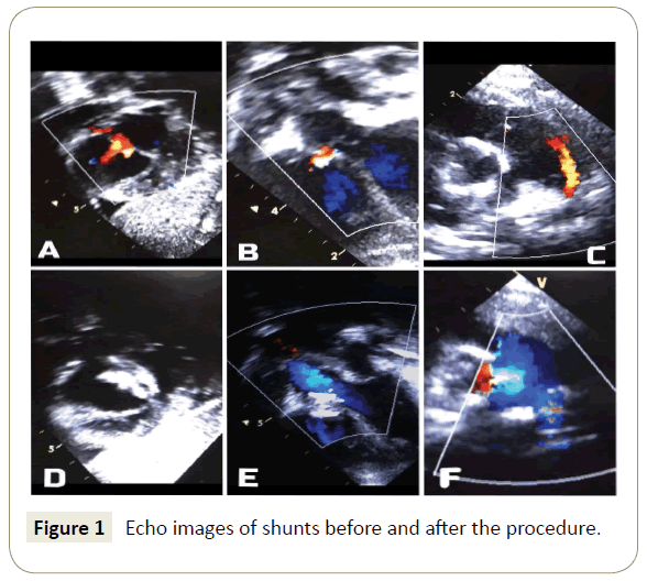 Simultaneous Transcatheter Device Closure Of Asd Vsd And Pda In An Infant With Down Syndrome Insight Medical Publishing