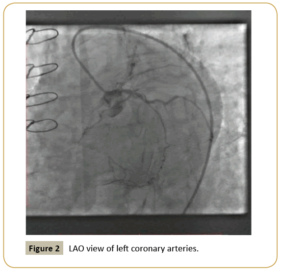 Download How To Treat A Case Of Post Coronary Artery Bypass Grafting Presenting With Myocardial Infarction Insight Medical Publishing