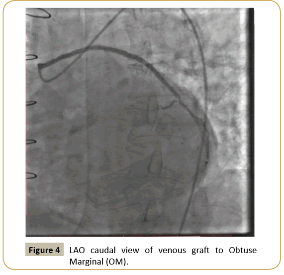 Download How To Treat A Case Of Post Coronary Artery Bypass Grafting Presenting With Myocardial Infarction Insight Medical Publishing