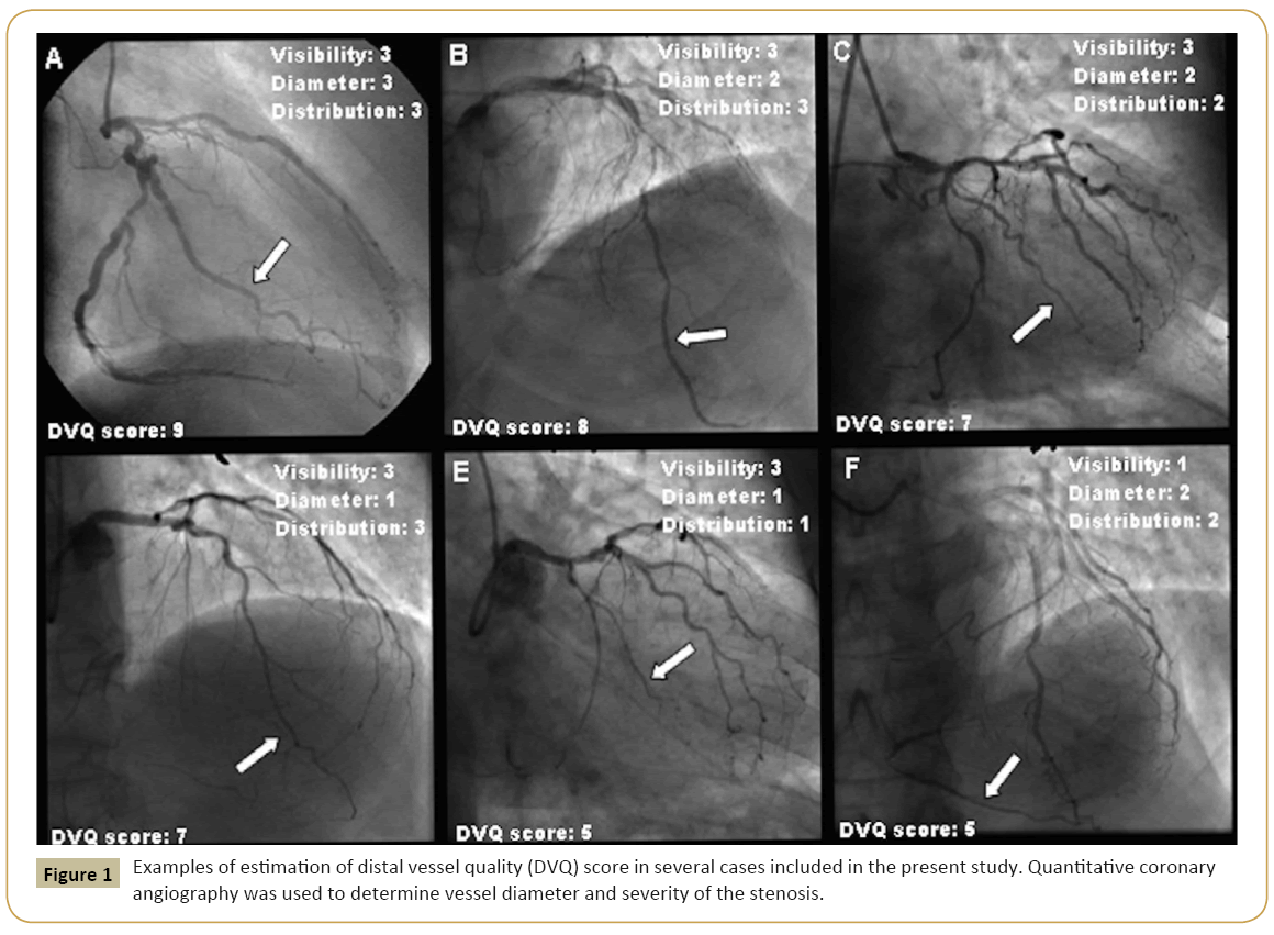 Download Distal Vessel Quality Score As A Predictor Of Graft Patency After Aorto Coronary Bypass Graft Towards The Optimization Of The Revascularization Strategy Insight Medical Publishing